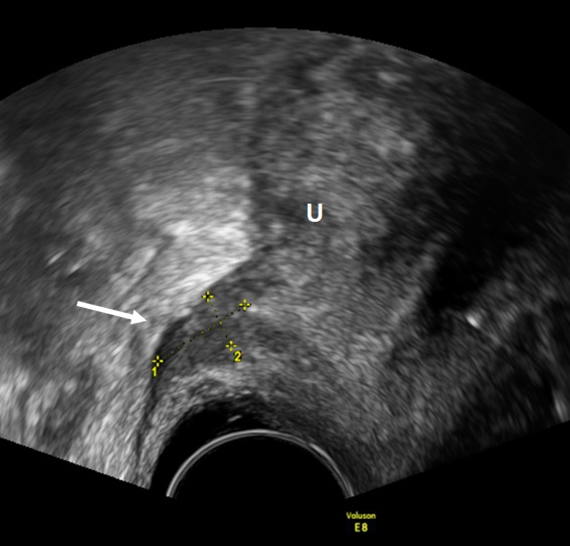 Transvaginal Ultrasound As Technique For Diagnosis Of Endometriosis