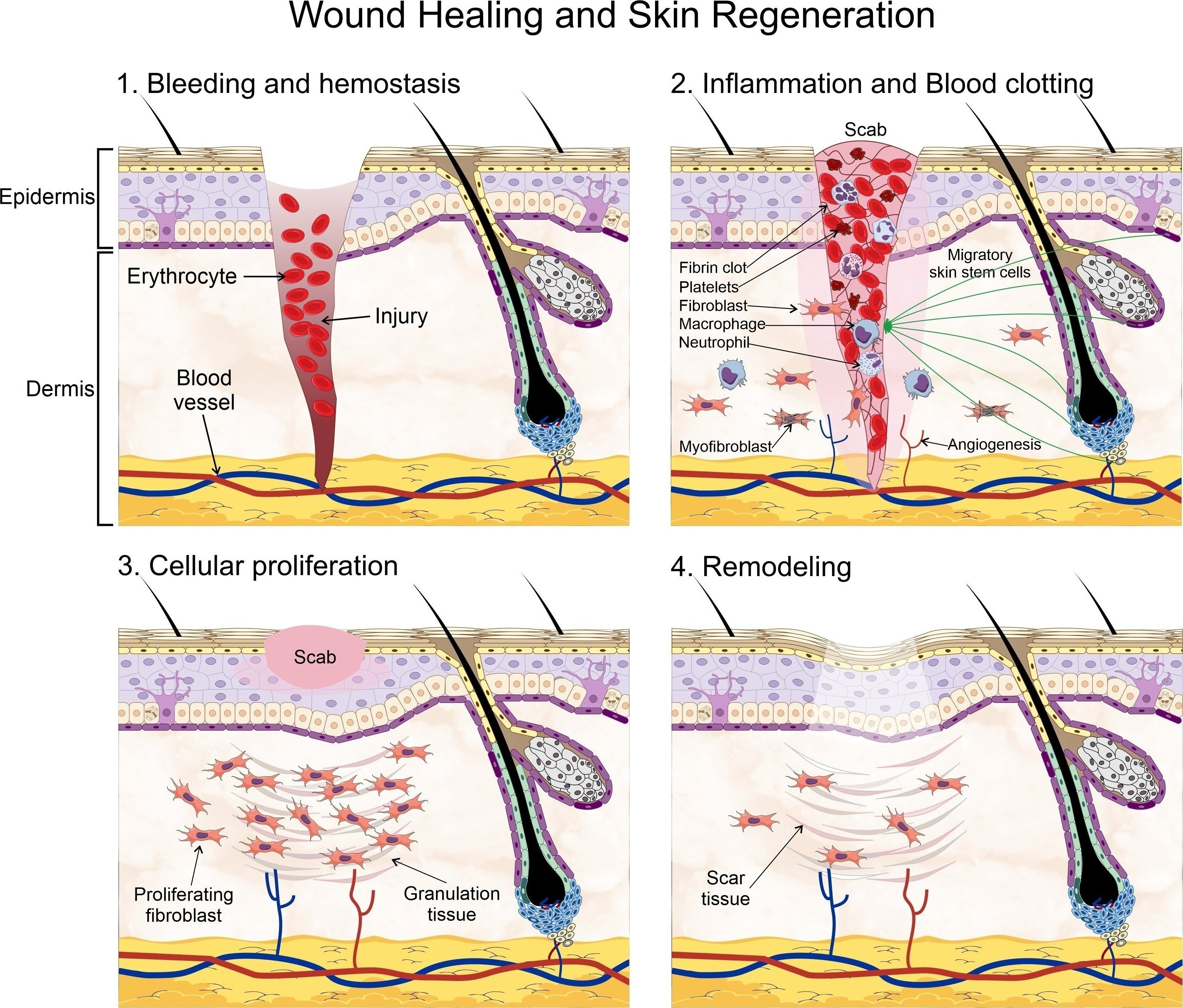 Wound healing process. Wound Healing and Skin Regeneration. Wound healing is a highly conserved mechanism that includes processes such as: 1. bleeding and hemostasis, in which blood flow slows and a clot forms to prevent blood loss during an injury, 2. Inflammation and blood clotting, in which the wound becomes sealed by fibrin which forms a temporary matrix occupied by immune cells whose task is to remove dead tissue and control infection, fibroblasts are then recruited into the site of the injury and promote angiogenesis and the recruitment of fibroblast-derived myofibro-blasts, which contract the wound area. Skin stem cells are mobilized into the site of injury at this stage to begin the pro-cess of re-epithelialization starting from the edge of the wound, 3. Cellular proliferation, in which the recruited fibro-blasts secrete collagen, and form granulation tissue, a scab is formed on the site of injury, and 4. Extracellular matrix (ECM) remodeling, in which new ECM components are secreted by both fibroblasts and epidermal keratinocytes, which also remodel the matrix through the expression of matrix metalloproteinases. Some elements of this figure were taken from the Mind the Graph platform, available at www.mindthegraph.com