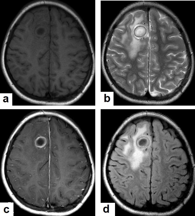 C:\Users\Admin\Documents\Term-1-1443\TB from Dr. Saif\Dr Saif images\USED IMAGES FROM DR SAIF\Cerebral abscess.jpg