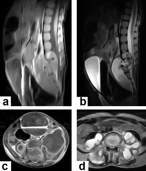 C:\Users\Admin\Documents\Term-1-1443\TB from Dr. Saif\Dr Saif images\USED IMAGES FROM DR SAIF\Potts.jpg