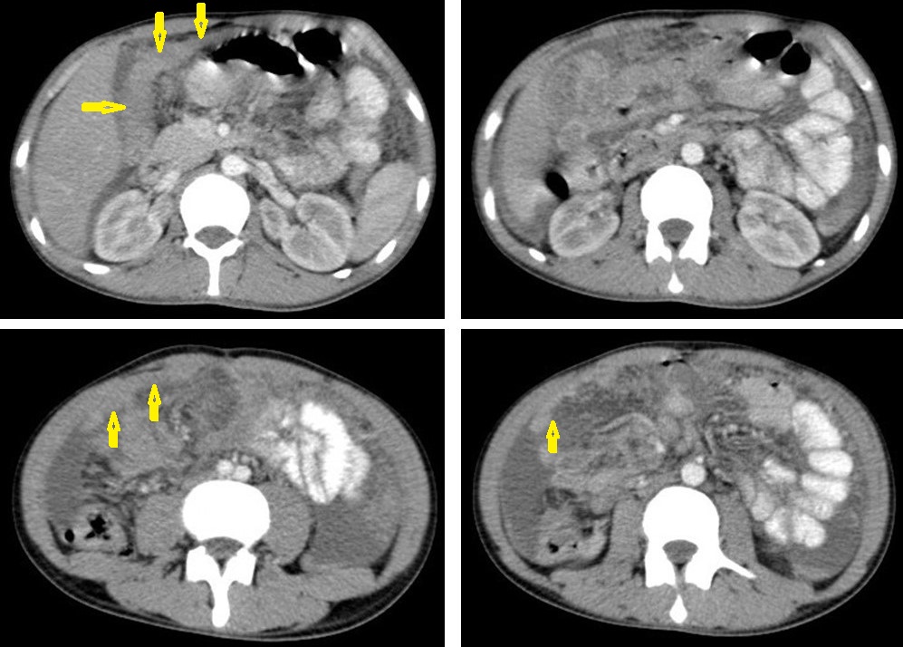 C:\Users\Admin\Desktop\Khaled Almass TB\Used images of TB\Used\Really used images\Finally used\Peritonitis.jpg