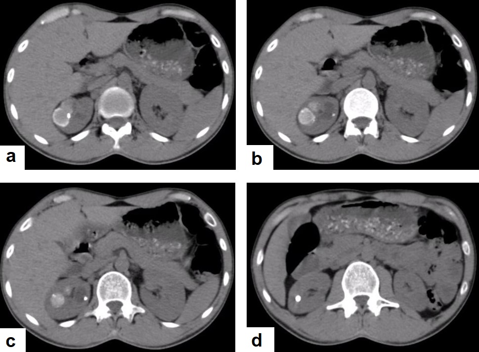 C:\Users\Admin\Documents\Term-1-1443\TB from Dr. Saif\Dr Saif images\USED IMAGES FROM DR SAIF\Renal TB.jpg