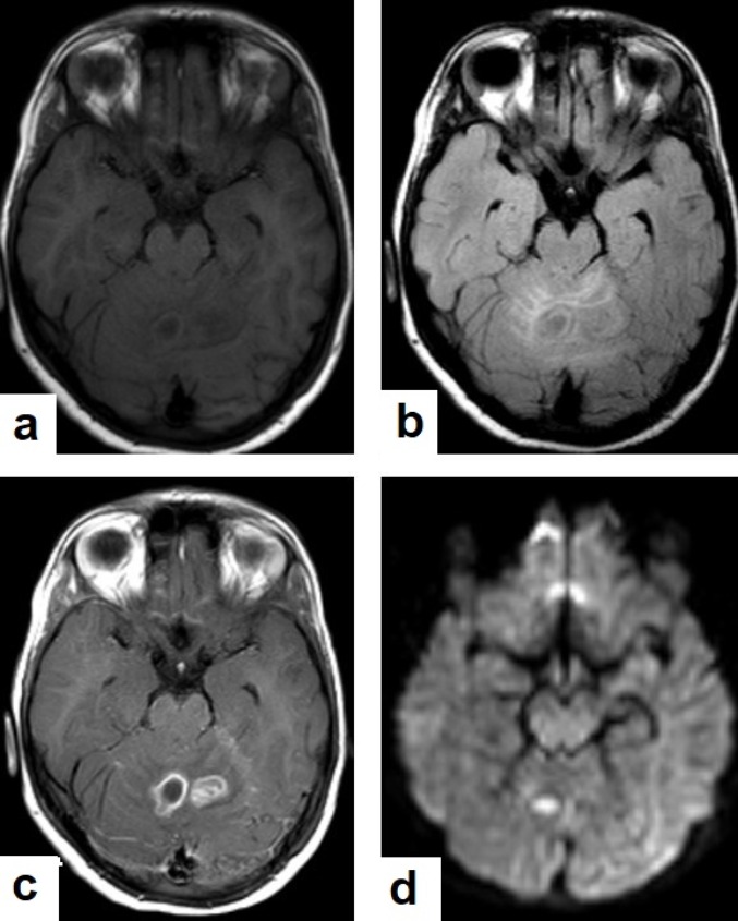 C:\Users\Admin\Documents\Term-1-1443\TB from Dr. Saif\Dr Saif images\USED IMAGES FROM DR SAIF\Cerebellar abscess.jpg