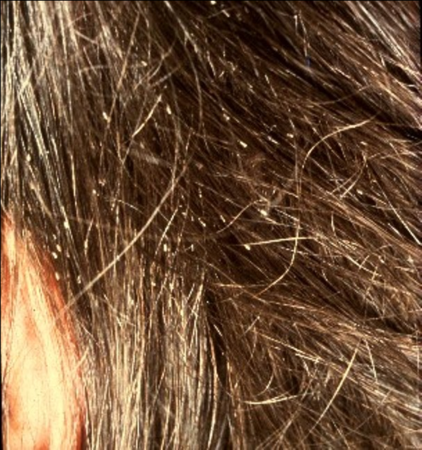 Treatment of Human Head Lice | Encyclopedia MDPI