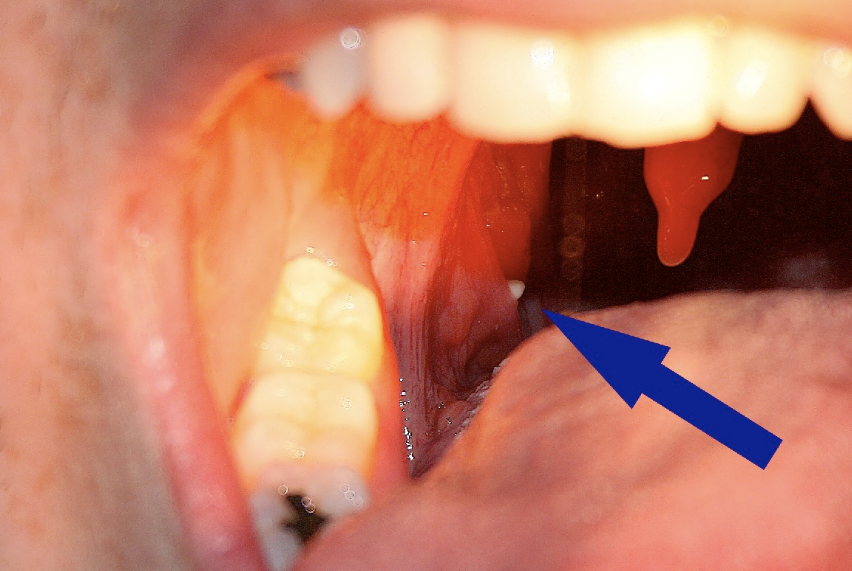 lingual tonsil bumps