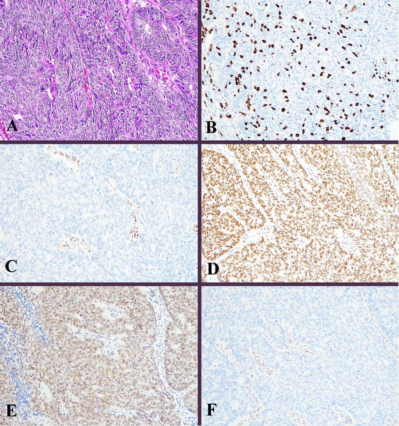 CD8, MMR, p53 in endometrial carcinoma | Encyclopedia MDPI