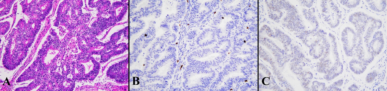 CD8, MMR, p53 in endometrial carcinoma | Encyclopedia MDPI