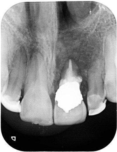 Final Treatment of a Tooth with Multiple External Root Resorption