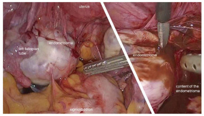 Endometriosis-Associated Ovarian Carcinomas