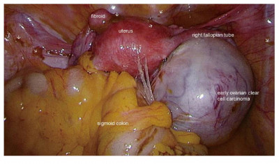 Ovarian Clear Cell Carcinoma