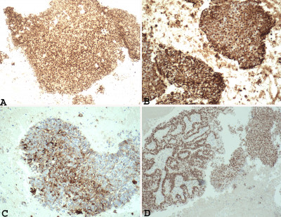 Example of Grade 3 Endometrial Carcinoma in Endometrial Curettage Specimens