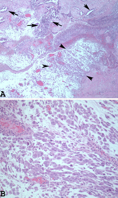 Dedifferentiated Rhabdoid Variant of Endometrial Endometrial Dedifferentiated Carcinoma