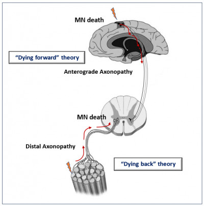 Schematic Representation Illustrating the Theories for Amyotrophic Lateral Sclerosis Onset