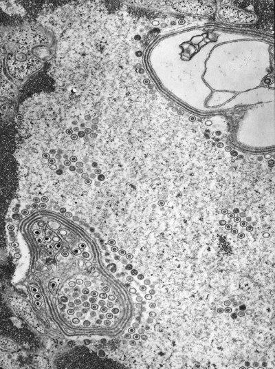 Transmission Electron Micrograph of Herpes Simplex Virions