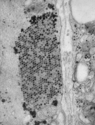 Transmission Electron Micrograph of Coxsackie B3 Virus