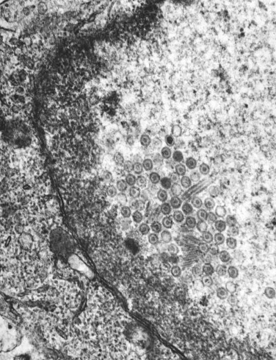 Transmission Electron Micrograph of Herpes Simplex Type-2 Virions