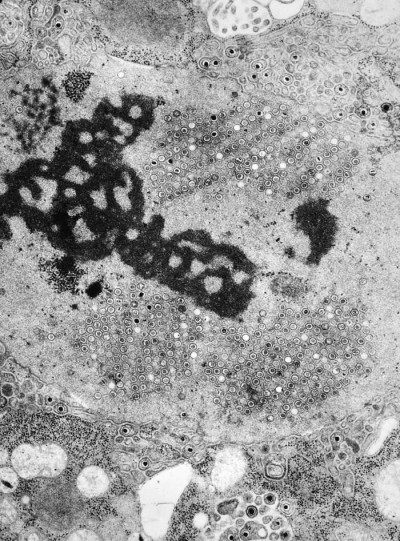 Transmission Electron Micrograph of Herpes Simplex Virions