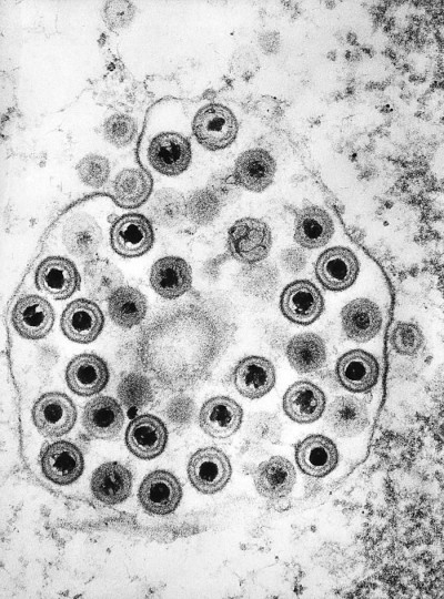 Transmission Electron Micrograph of Numerous Herpes Simplex Virions