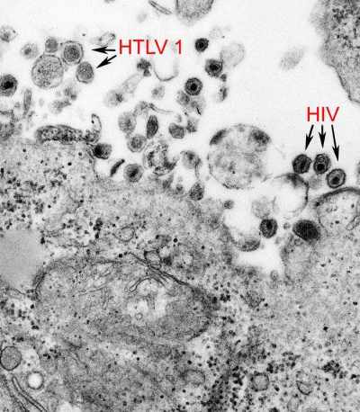 Transmission Electron Microscopic Image of HTLV-1 and HIV-1