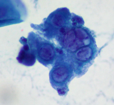 Herpes-Infected Cells in SurePath Pap Smear