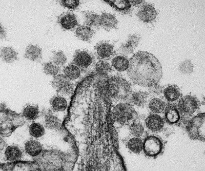 Transmission Electron Micrograph of MERS Coronavirus Particles