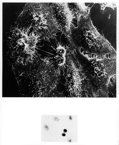 Scanning Electron Micrograph of HeLa Cells with Adenovirus