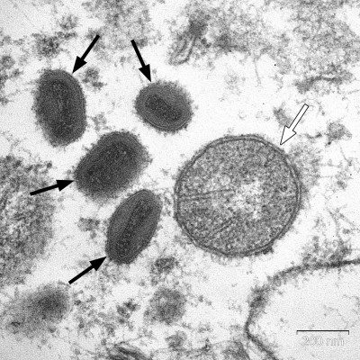 Vaccinia Virus Particles in the Cytoplasm of Human Carcinoma Cell