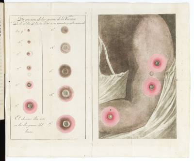 Fold out Illustration of Arm with Smallpox Pustules