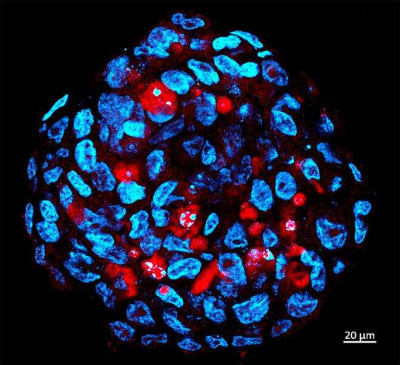 Human Medulloblastoma Stemcells Infected by Zika