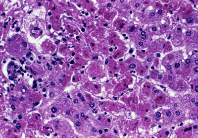 Marburg Virus Liver Injury