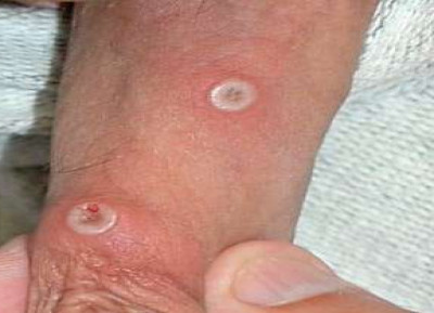 Monkeypox Lesions