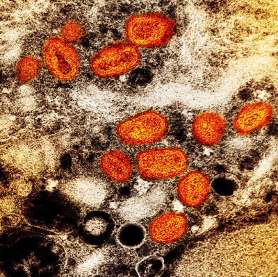 Monkeypox Virus