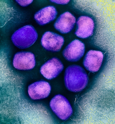 Monkeypox Virus