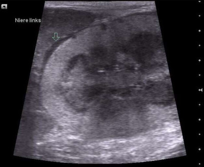 Sonogram of Malign Lymphoma in the Kidney of a Cat