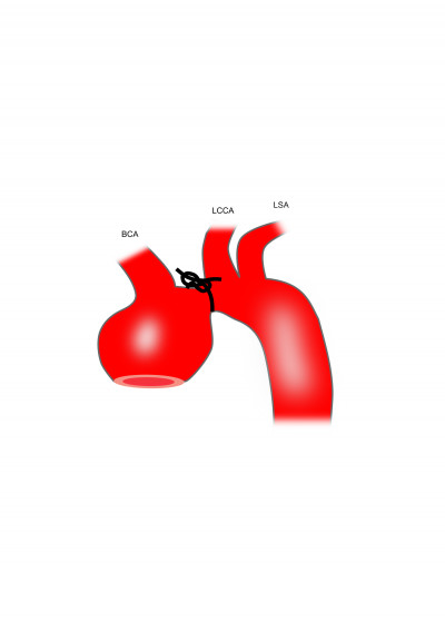 Preparation of Mouse TAA Using Transverse Aortic Constriction