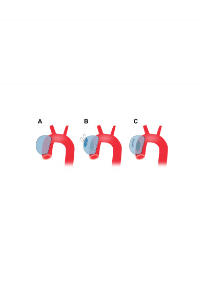 Preparation of Porcine Thoracic Aortic Aneurysm Using the Cover-Then-Cut Method