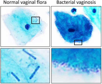 Normal Vaginal Flora Versus Bacterial Vaginosis on Pap Stain