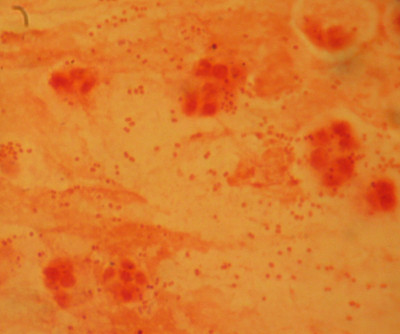 Haemophilus influenzae Gram