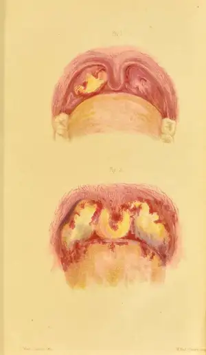 Throat of Adult and of a Child Infected with Diphtheria