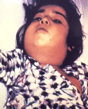 Child with Diphtheria Presenting Bull Neck Swelling