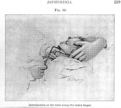 Incubation of Larynx in Diptheria, in Koplik