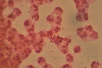 Pus Cells with Neisseria gonorrhoeae