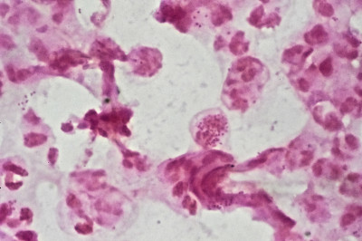 Neisseria gonorrhoeae in Pus