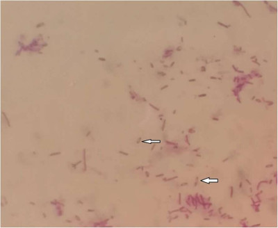 Burkholderia pseudomallei Gram Stain Safety Pin Apperance