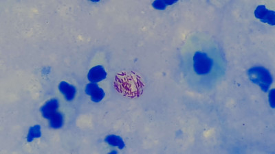 Mycobacterium leprae in Ziehl-Neelsen Stained Smear of Sputum