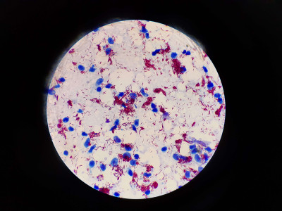 Mycobacterium leprae in Magnification of 1000X