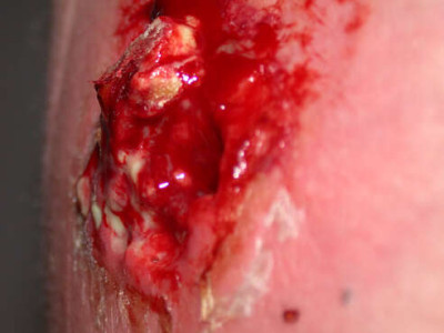 Methicillin-Resistant Staphylococcus aureus Cyst Exploded