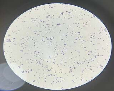 Gram Stain of Sample Containing Staphylococcus aureus