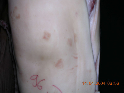 Skin Lesions of Erysipelas