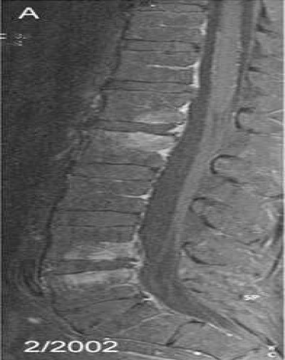 Spondylitis Tropheryma whipplei